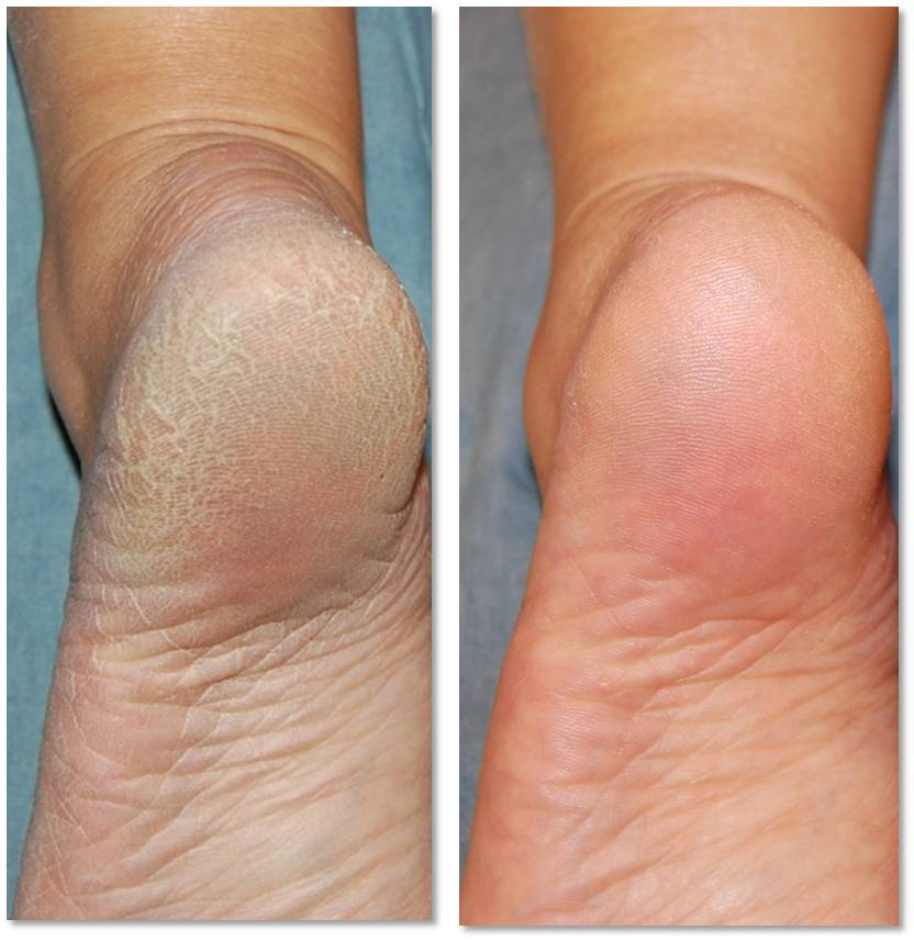 Il dispositivo per cura di psoriasi di psoriamed il prezzo